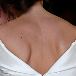 Cicatricea de pe spatele Prințesei Eugenie, pe spate, în ziua nunții, îmbrăcată în rochie albă de mireasă