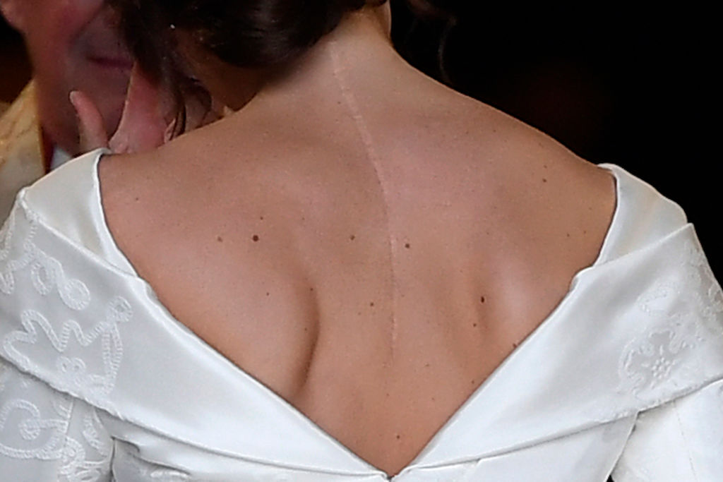 Cicatricea de pe spatele Prințesei Eugenie, pe spate, în ziua nunții, îmbrăcată în rochie albă de mireasă