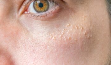 iritație în jurul ochiului, predominant sub ochi, aspect de umblături mici și albe