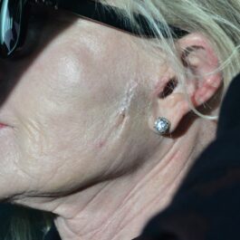 Fața actriței Melanie Griffith cu o cicatrice vizibilă
