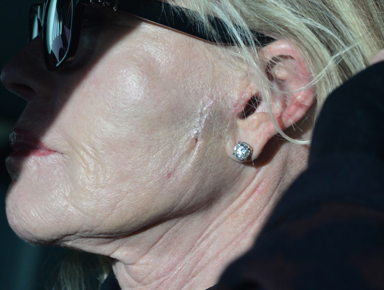 Fața actriței Melanie Griffith cu o cicatrice vizibilă