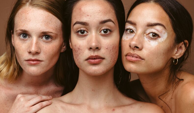 Trei femei tinere și frumoase care se confruntă cu probleme de piele în zona tenului