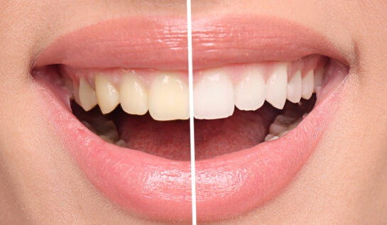 Evită aceste greșeli de periaj pentru dinți mai albi