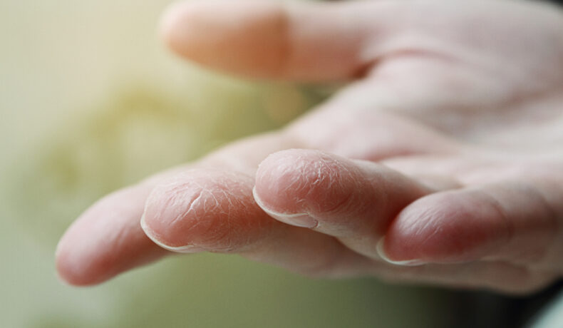 Mâinile unei femei cu piele uscată și crăpată