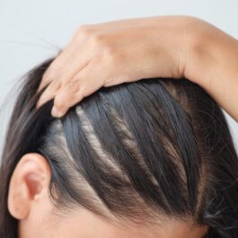 O femeie care se confruntă cu păr rărit și căderea firelor