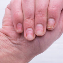 O femeie care se confruntă cu o problemă la unghiile de la mână