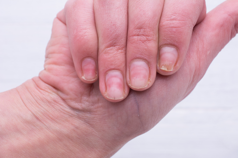 O femeie care se confruntă cu o problemă la unghiile de la mână